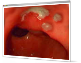 Ulcer bug breakthrough